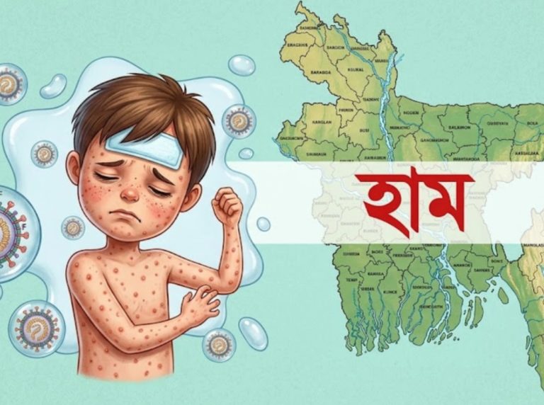 হাম উপসর্গে আরও ৯ শিশুর মৃত্যু, আক্রান্ত ৯৪৫