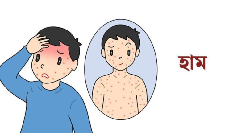 হাম পরিস্থিতি ভয়াবহ, মৃত্যু ছাড়াল ৭০০