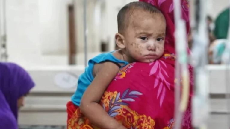 হামের উপসর্গে মৃত্যুর সংখ্যা বেড়ে ৬৪৮