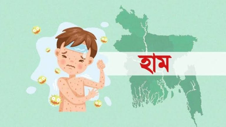 হাম উপসর্গে আরও ৪ শিশুর মৃত্যু, নতুন শনাক্ত ১০০৮
