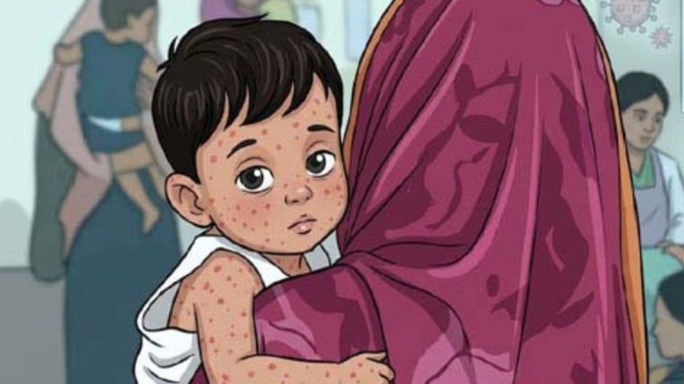 হামের উপসর্গ নিয়ে আরও ৬ মৃত্যু, শনাক্ত ৭৮