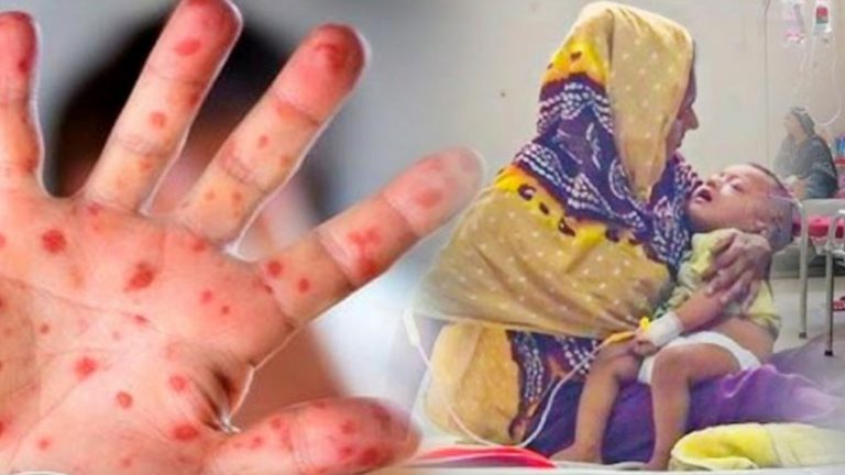হামে আরও ৮ শিশুর মৃত্যু, প্রাণহানি বেড়ে ৯০২
