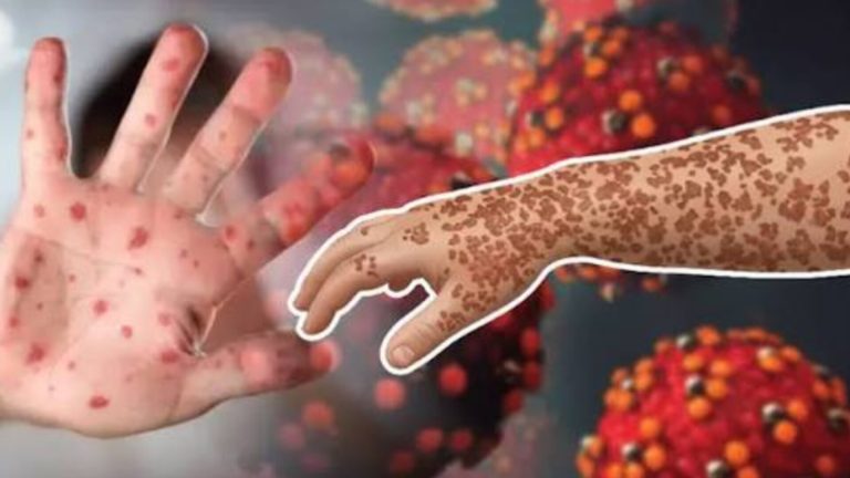 হামে আরও ৬ শিশুর মৃত্যু, নতুন আক্রান্ত ১,১০১