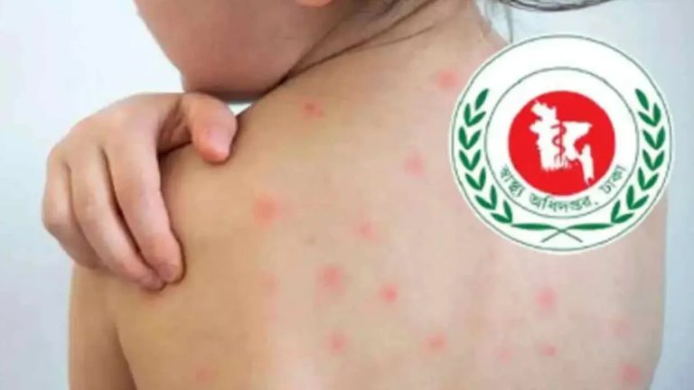 হামের ছোবলে আরও ৭ শিশুর মৃত্যু